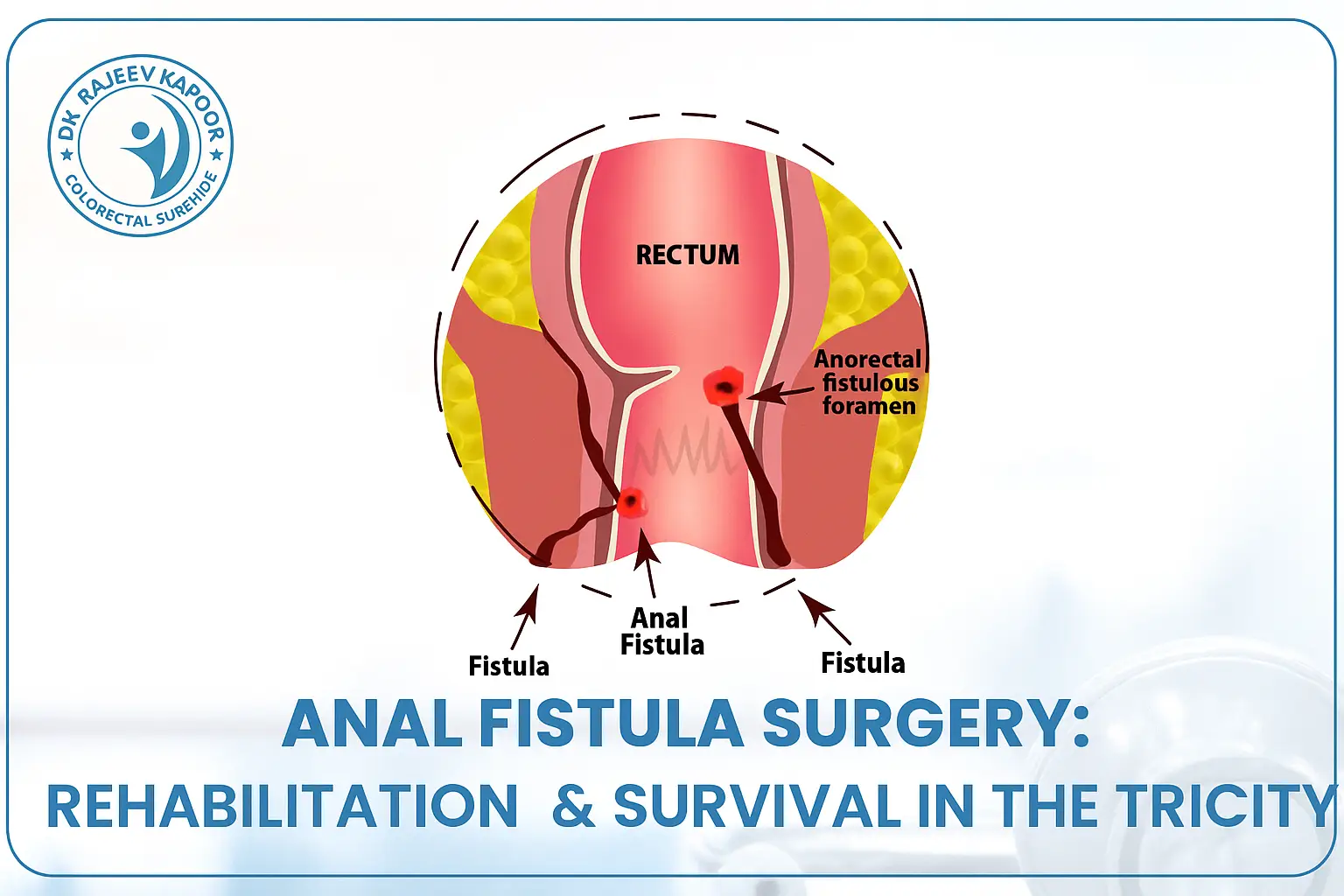 Anal Fistula: Surgery is the Best Bet