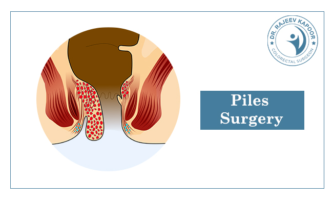 Piles Surgery Doctor in Chandigarh