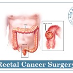 Rectal Cancer Surgeon In Chandigarh