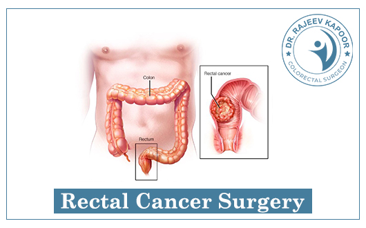 Rectal Cancer Surgeon In Chandigarh