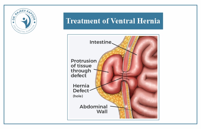 Treatment of Ventral Hernia
