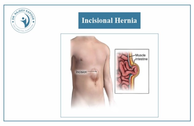 incisional Hernia