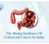 The Rising Incidence of Colorectal Cancer In India