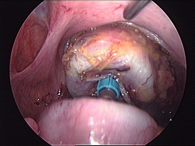 colon lap surgery