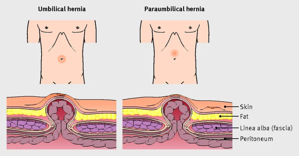 hernia-surgeon-in-chandigarh