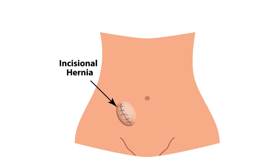 hernia-surgeon-in-chandigarh