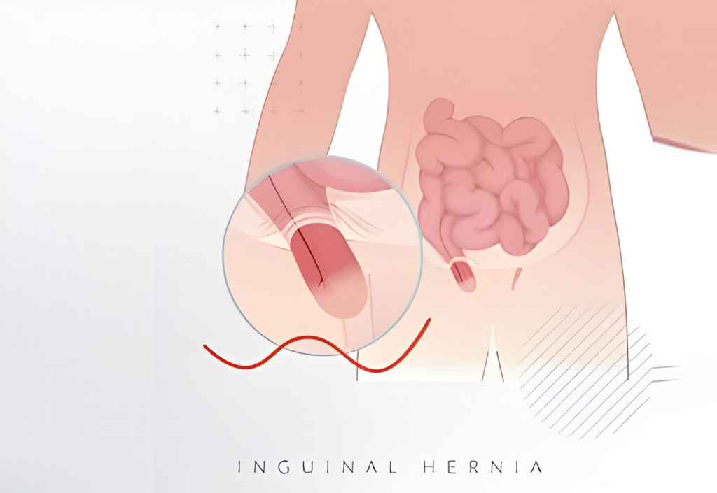 hernia-surgeon-in-chandigarh