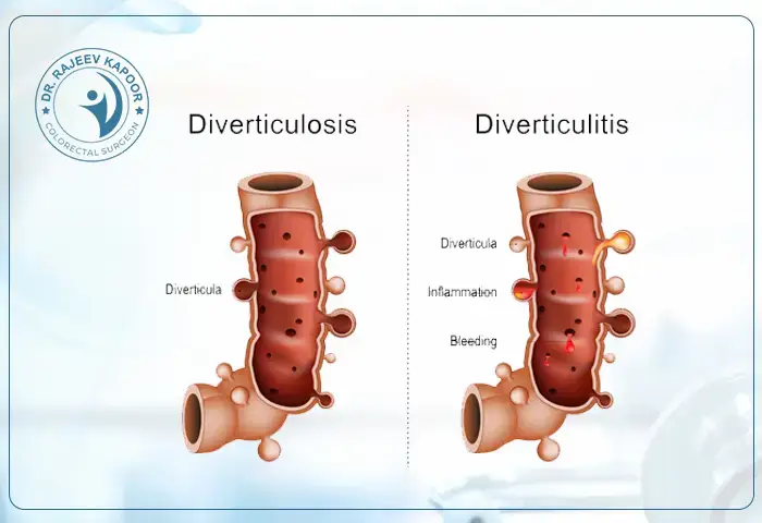 Diverticular Surgery