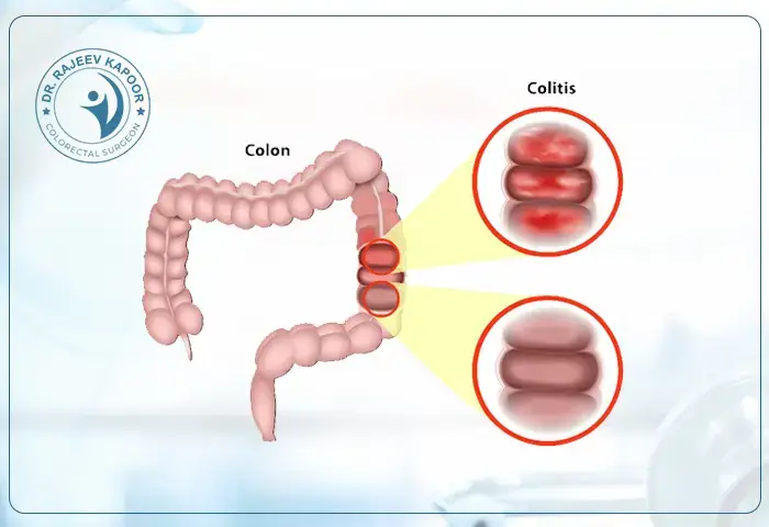 Colitis