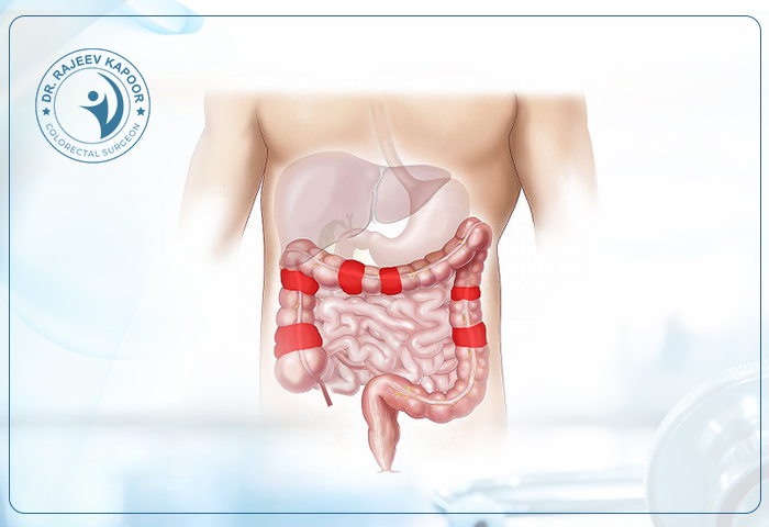 Crohns Disease