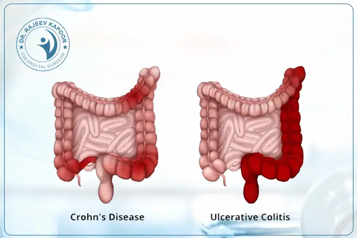 Colitis