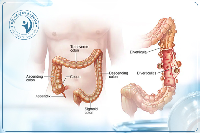 Diverticular Surgery