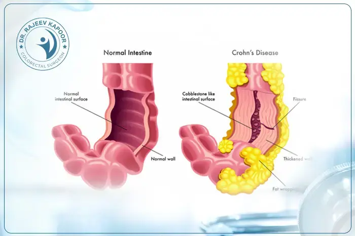 Crohns Disease