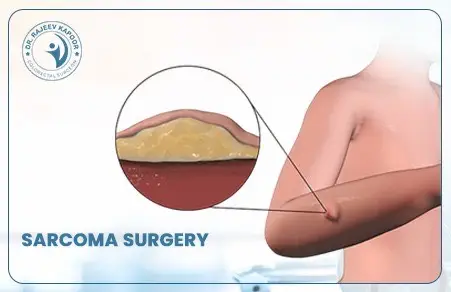 Sarcoma Surgery: Diagnosis, Treatment & Recovery