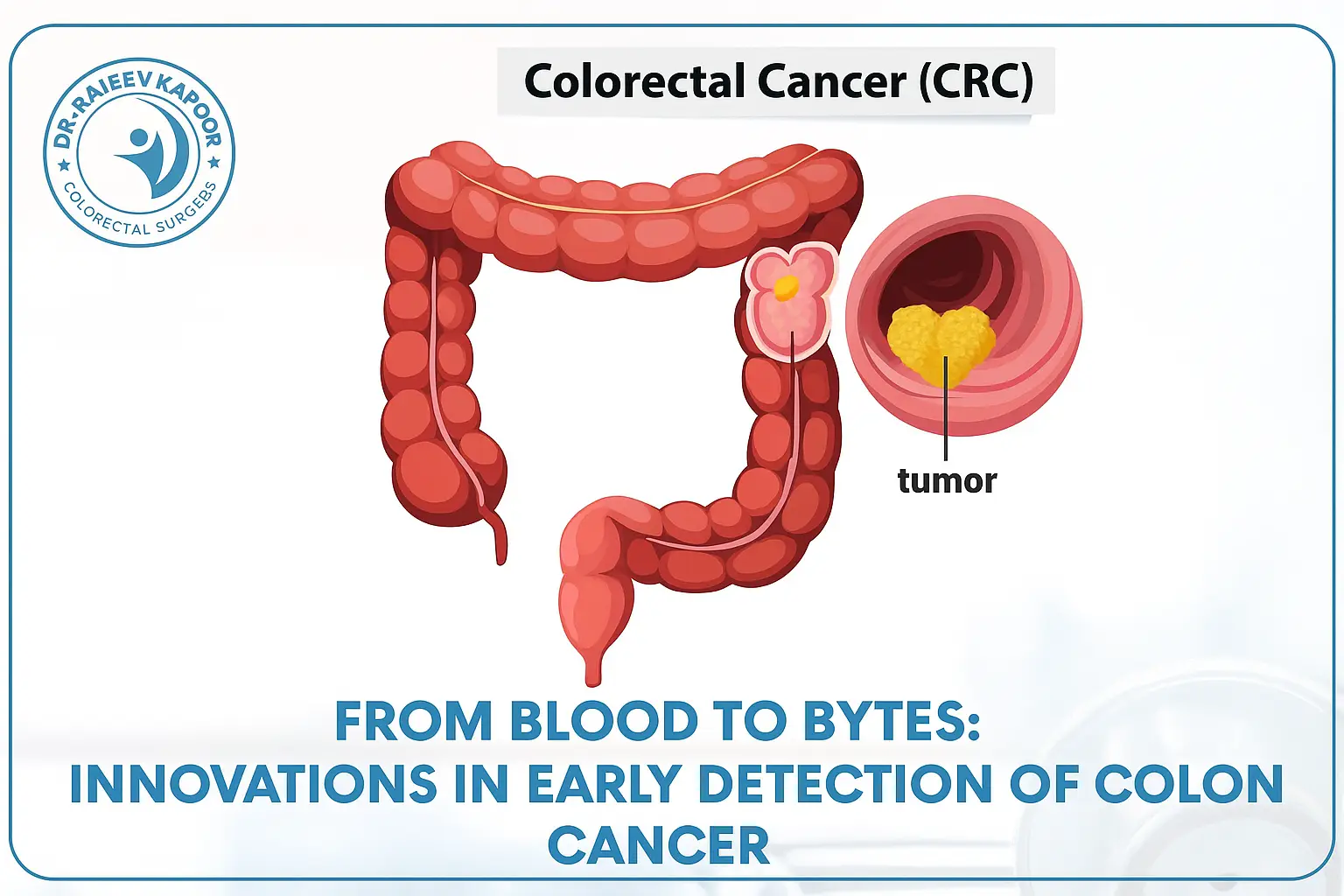 From Blood to Bytes: Innovations in Early Detection of Colon Cancer