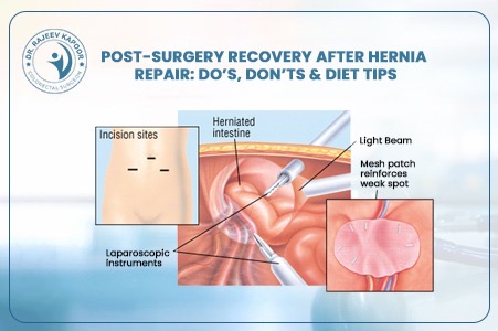 After Hernia Repair