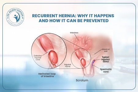 Recurrent Hernia in Chandigarh