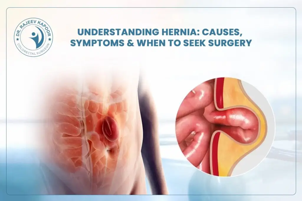 Understanding Hernia: Causes, Symptoms, and When to Seek Surgery