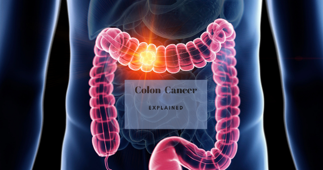 colon cancer Mohali