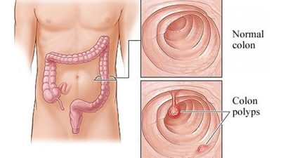 colon-young-adults