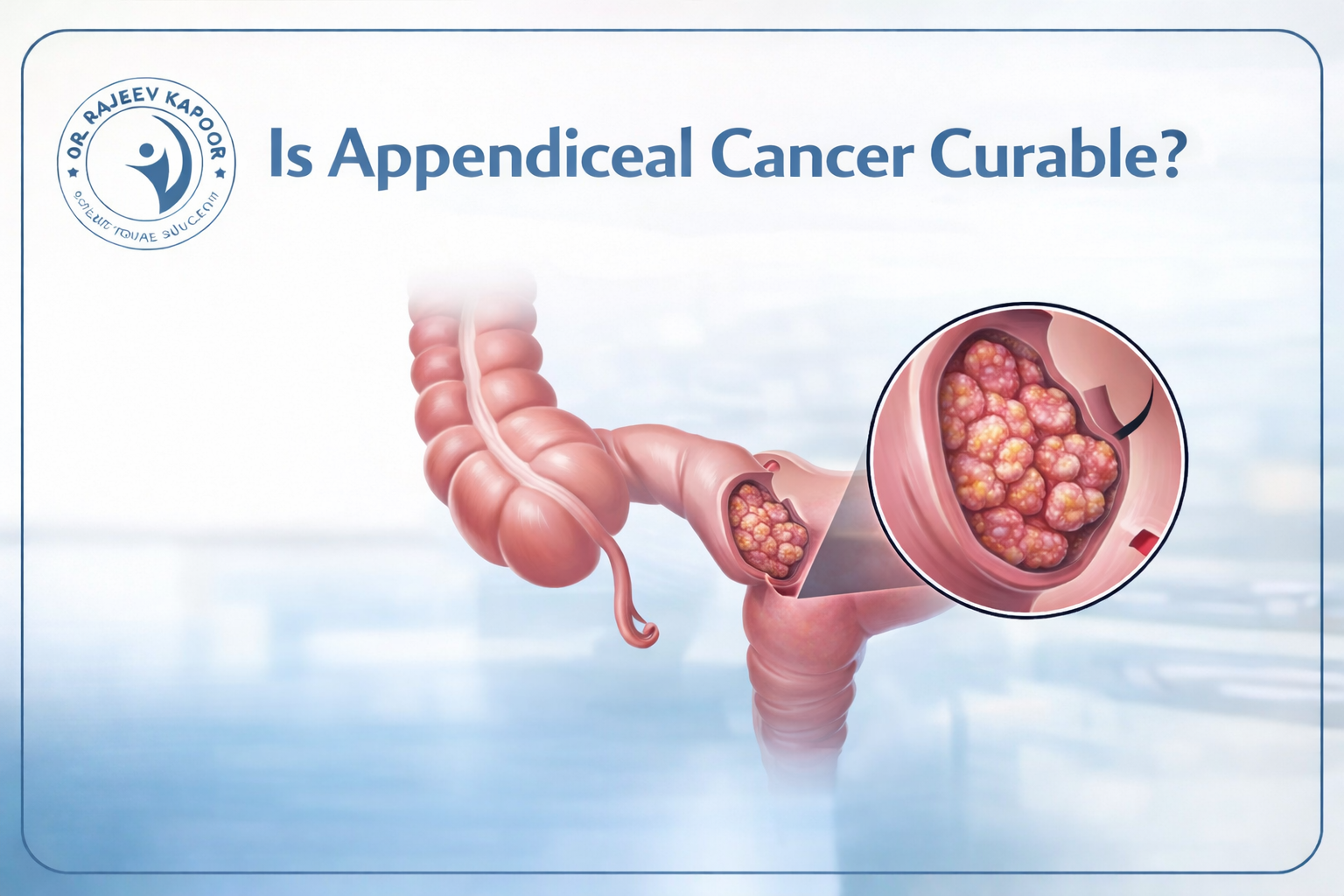 Is Appendiceal Cancer Curable?