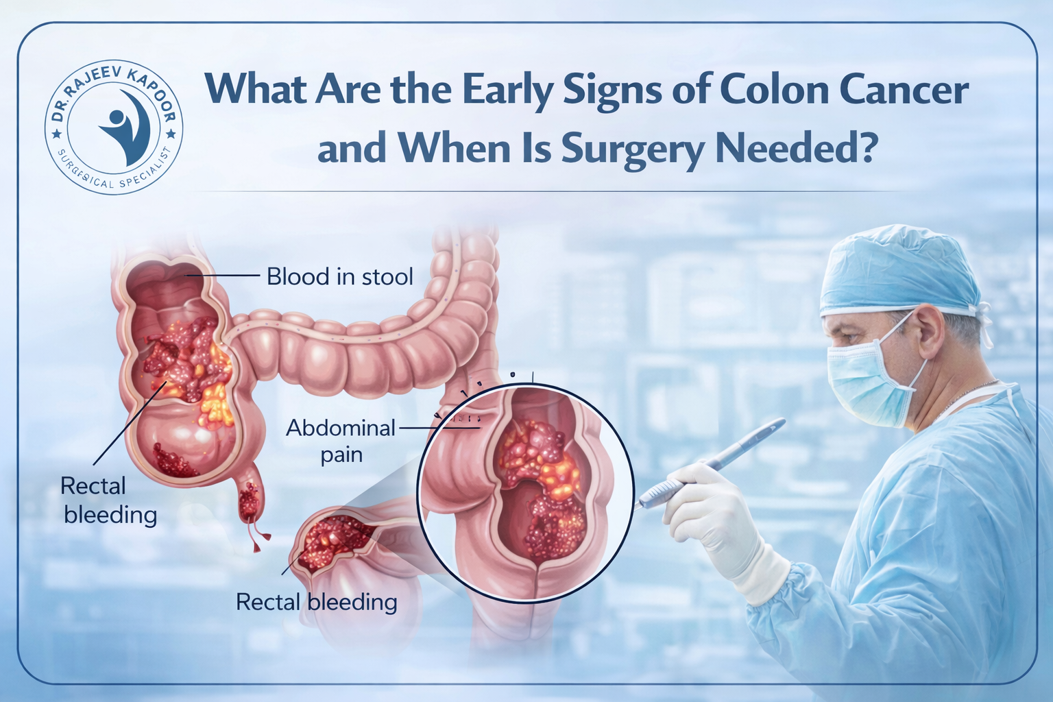 What Are the Early Signs of Colon Cancer and When Is Surgery Needed?