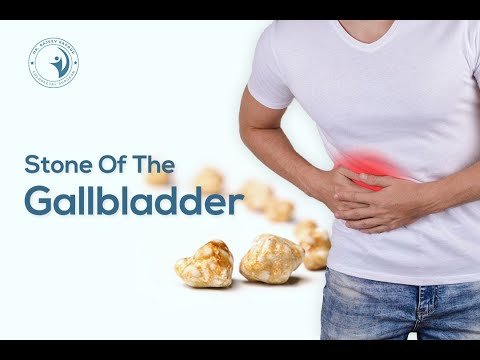 All About Gallbladder Stones — laparoscopic surgery explained by Dr. Rajeev Kapoor
