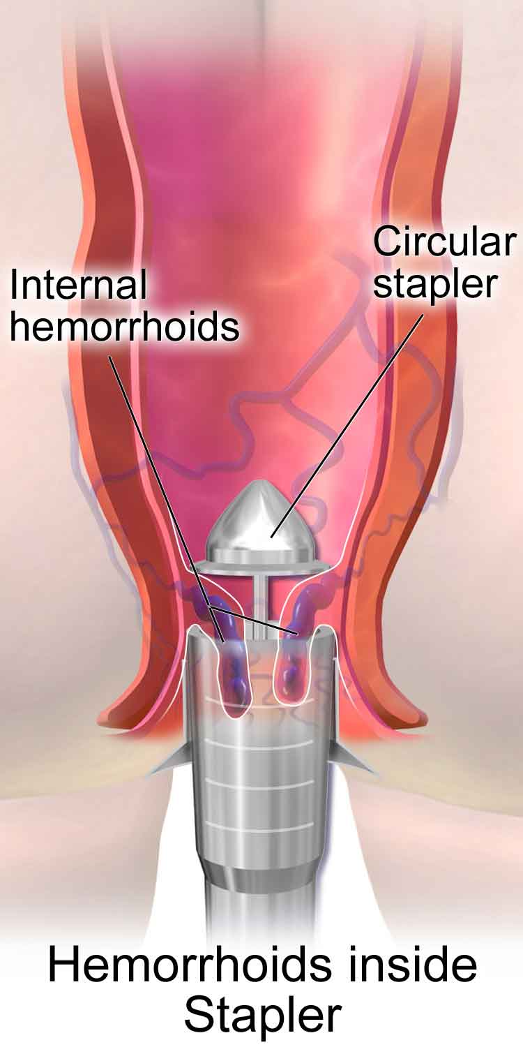 Medical illustration of stapled haemorrhoidopexy showing circular stapler positioning internal hemorrhoids