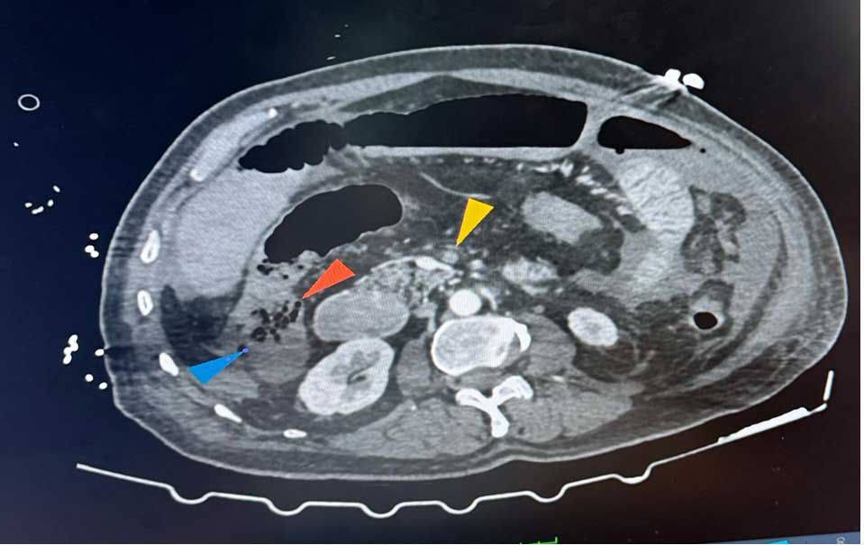 Annotated CT scan of the abdomen used in colorectal cancer surgery planning