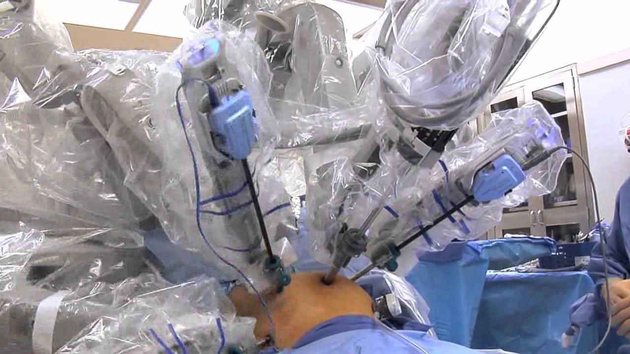 Close-up of Da Vinci robotic arms with surgical instruments positioned during minimally invasive surgery