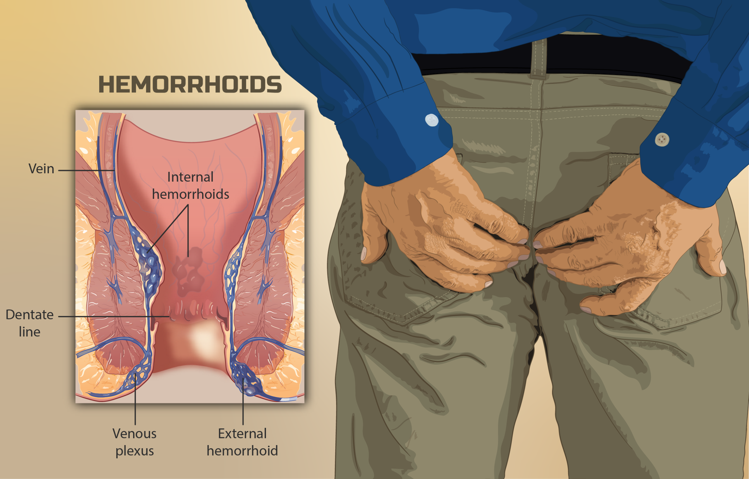 Diagram showing internal and external hemorrhoids (piles) with anatomy of the anal canal
