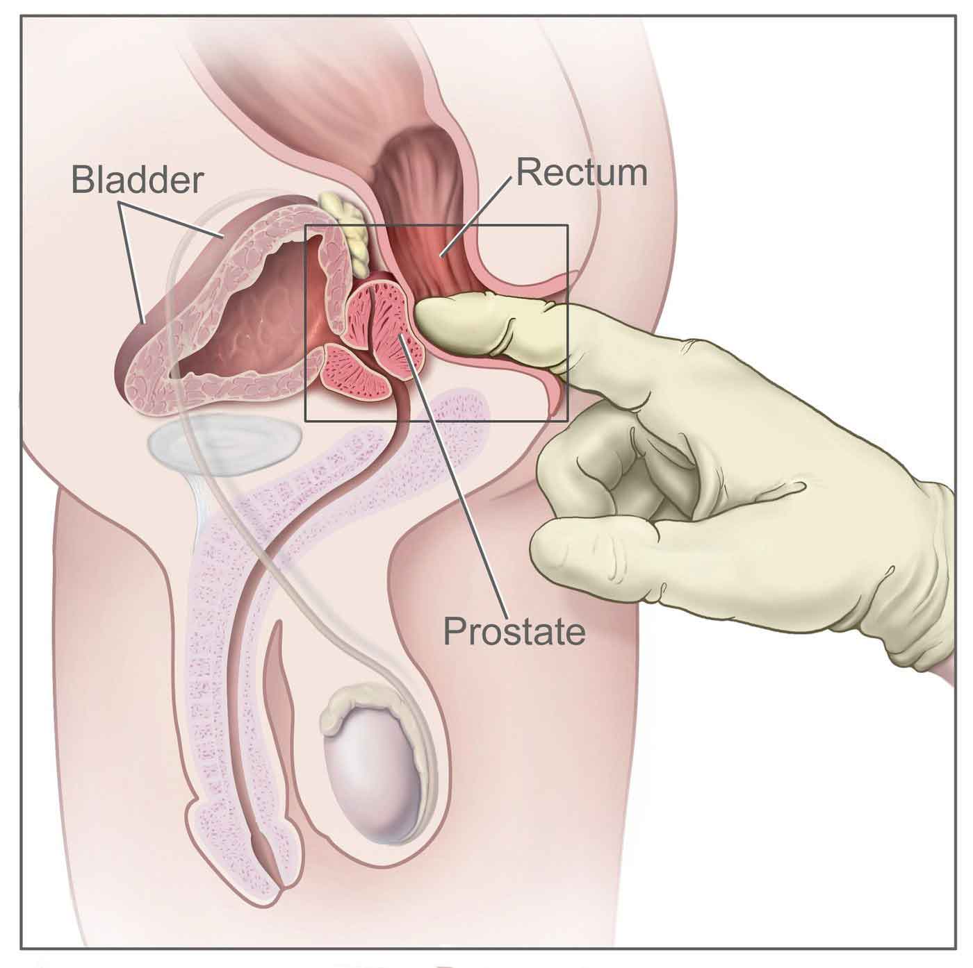 Illustration of a digital rectal examination (DRE) showing the doctor's gloved finger examining the rectum