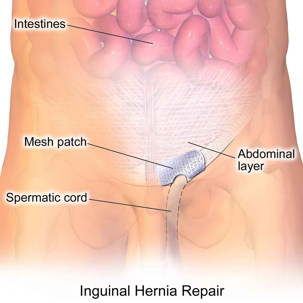 Illustration showing the anatomy of an inguinal hernia repair with mesh