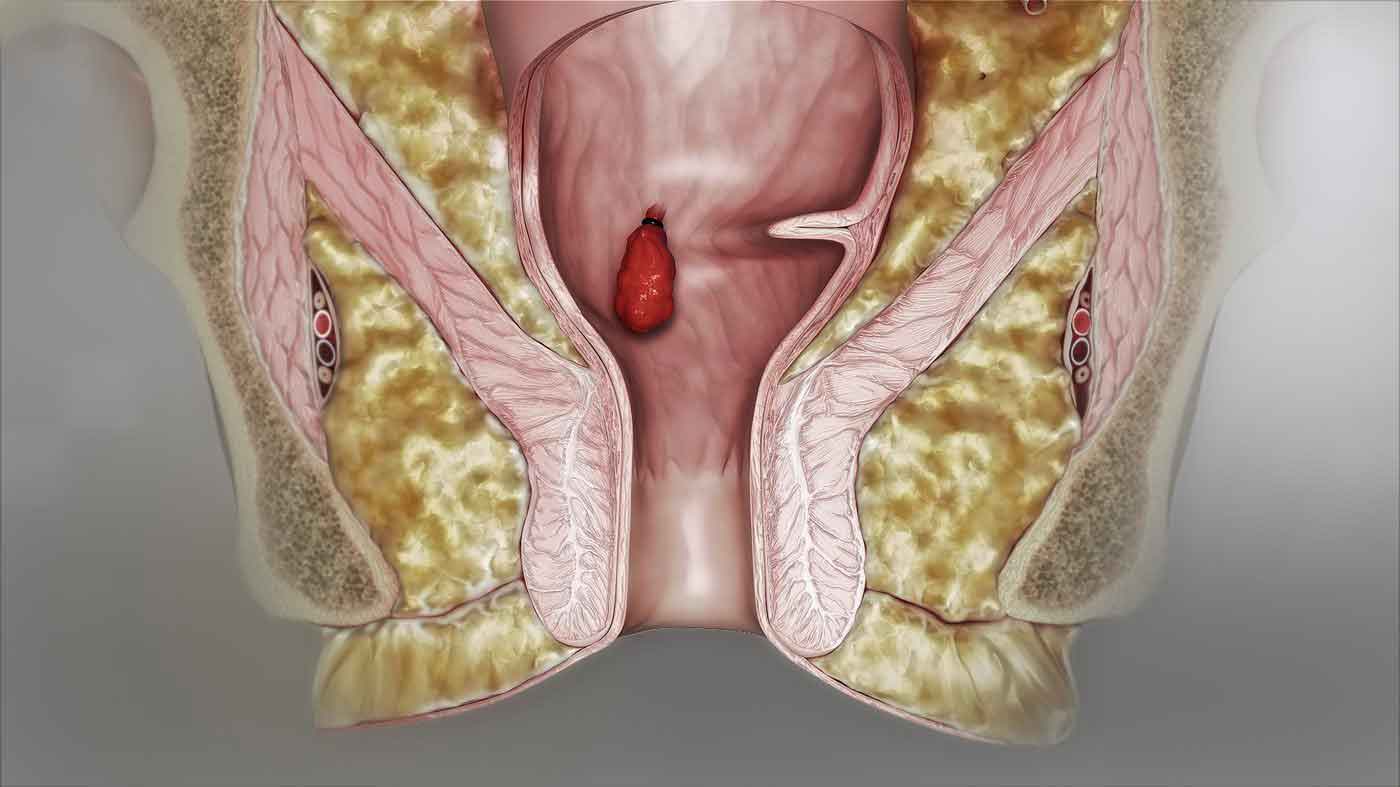 Medical illustration showing rubber band ligation of an internal hemorrhoid inside the anal canal