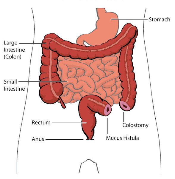 Surgery for Colorectal Cancer