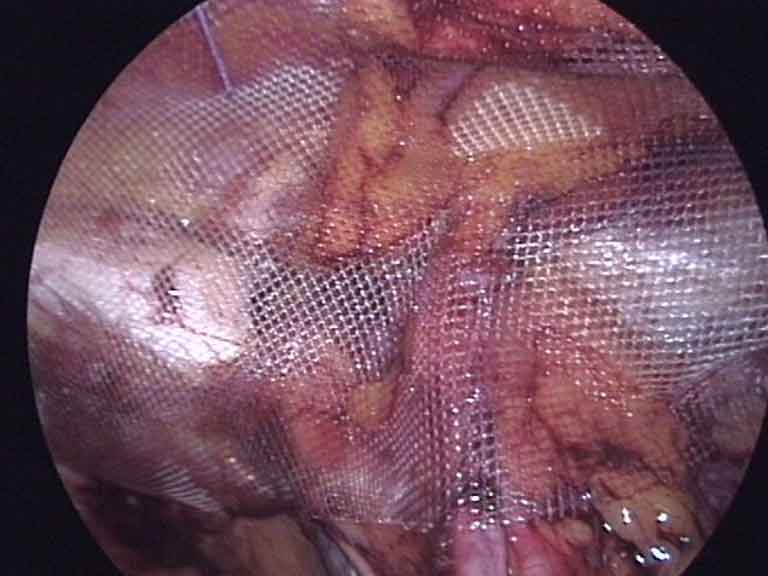 Laparoscopic inguinal hernia repair — TEP mesh placement in groin
