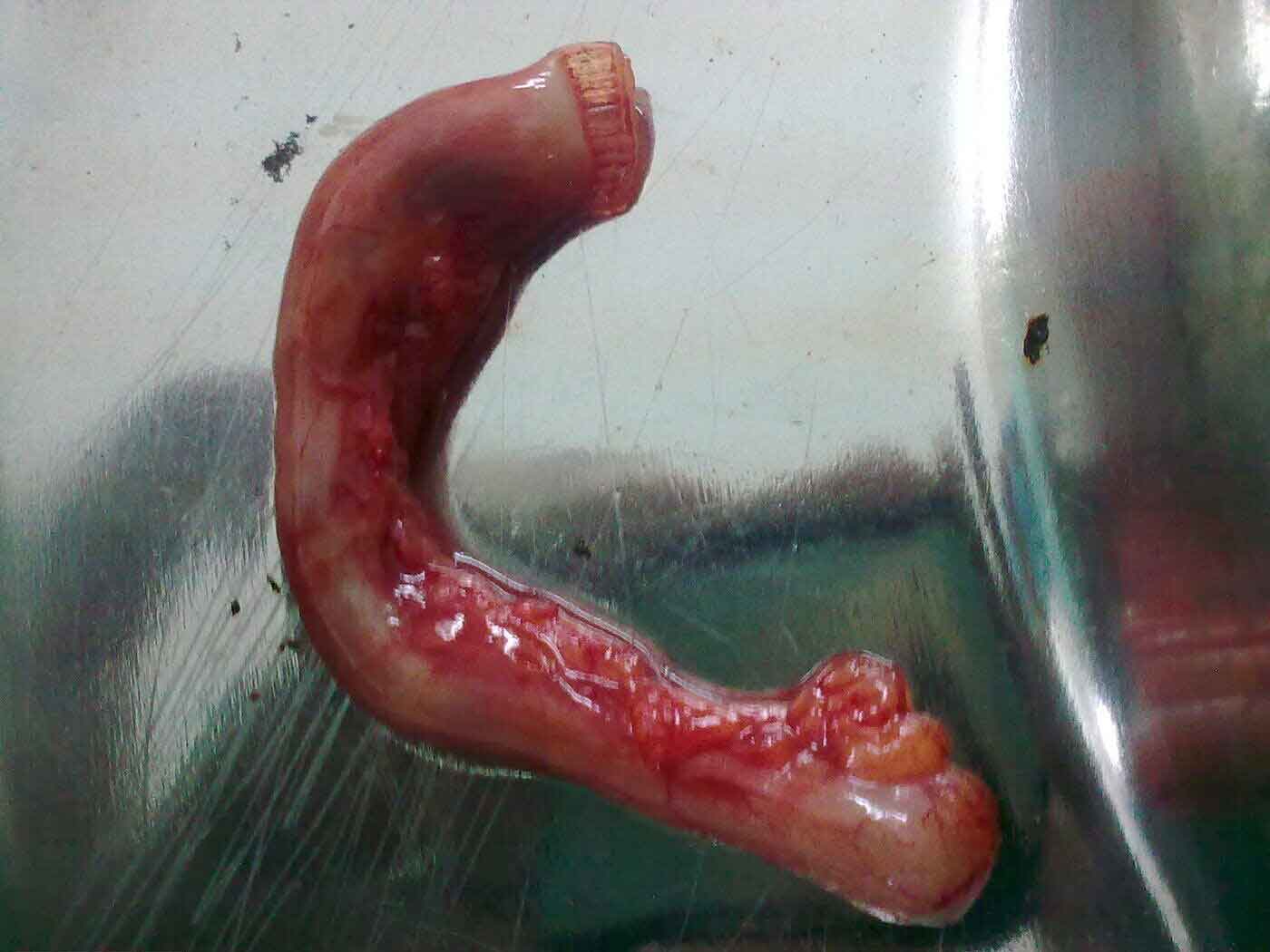 Removed appendix specimen after laparoscopic appendicectomy