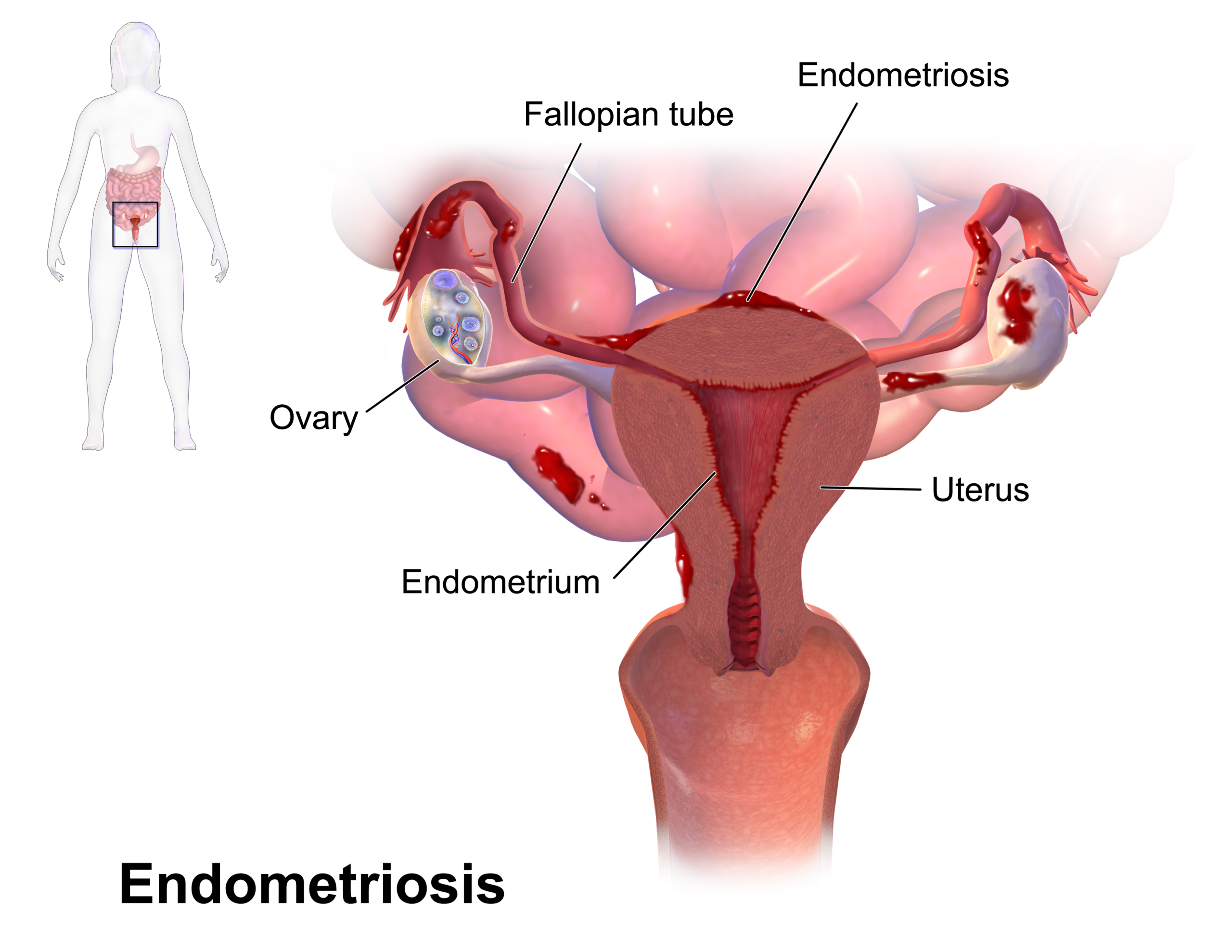 Diagram showing internal and external hemorrhoids (piles) with anatomy of the anal canal