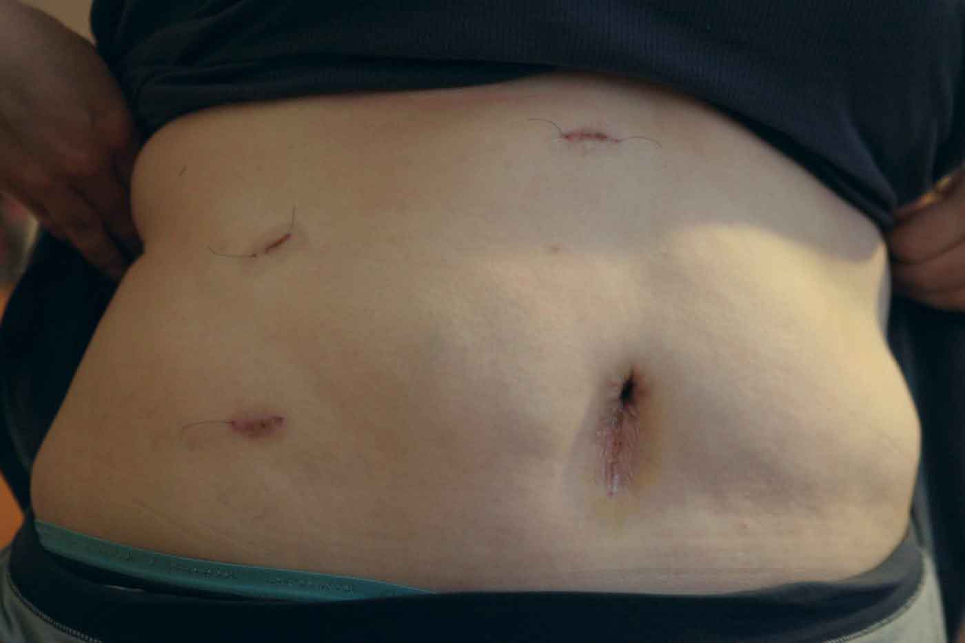 Four small laparoscopic port incisions four days after gallbladder surgery