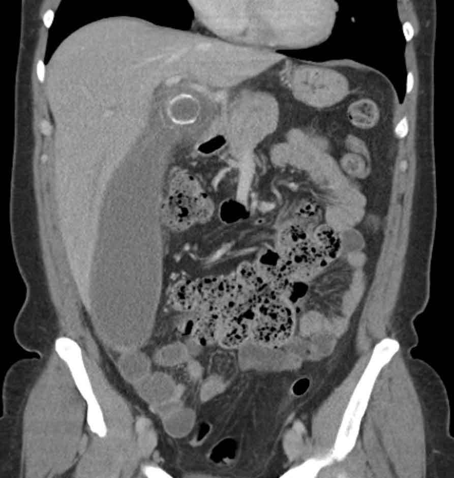 Imaging showing an enlarged gallbladder with gallstones — cholecystitis