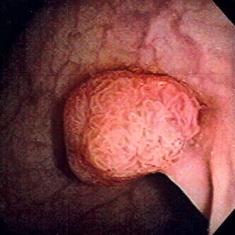 Colonoscopy view showing a polyp inside the colon