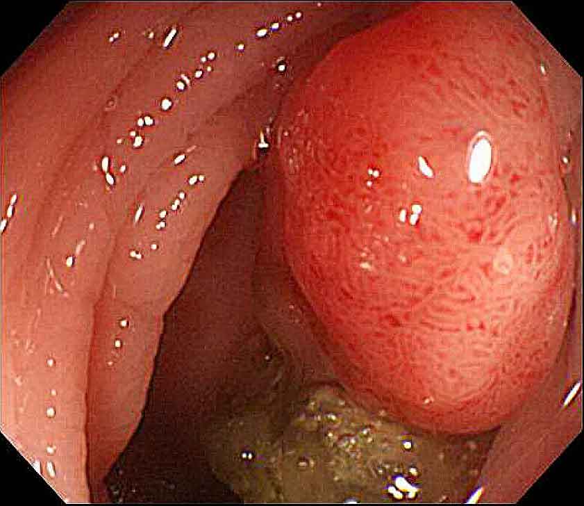 Colon polyp seen on colonoscopy — a small raised growth on the bowel lining