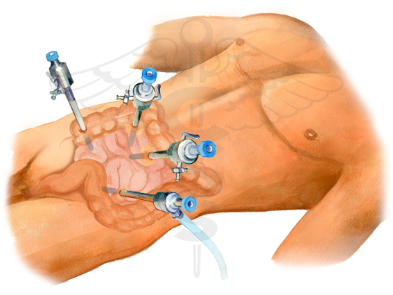 3D anatomical illustration of the colon and rectum highlighting colorectal cancer — conditions treated by Dr. Rajeev Kapoor