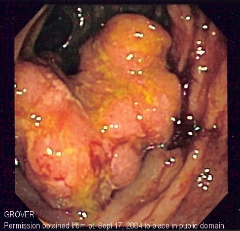 Endoscopic view showing colorectal cancer — advanced lesion seen during colonoscopy