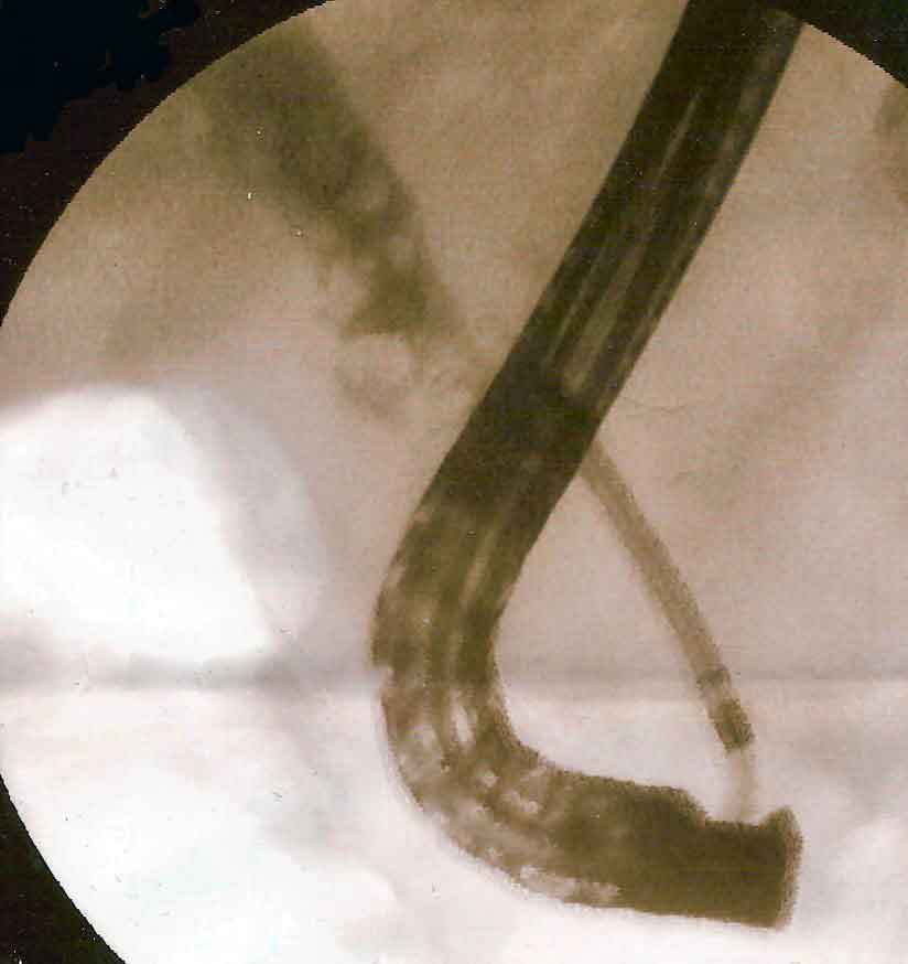 ERCP fluoroscopy showing stone extraction from the common bile duct