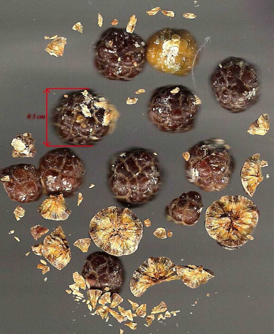 Gallstones of varying sizes and colours removed during cholecystectomy