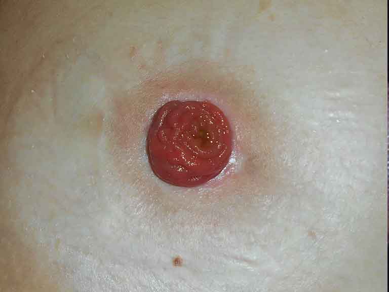 Well-healed ileostomy stoma on abdominal wall after laparoscopic surgery