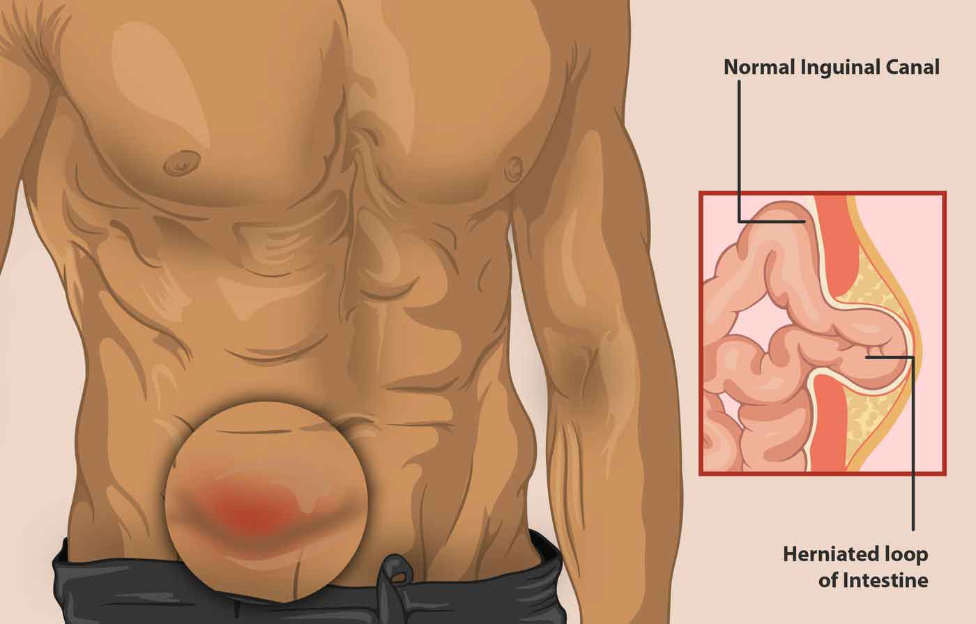 Visible bilateral inguinal hernia in a male patient