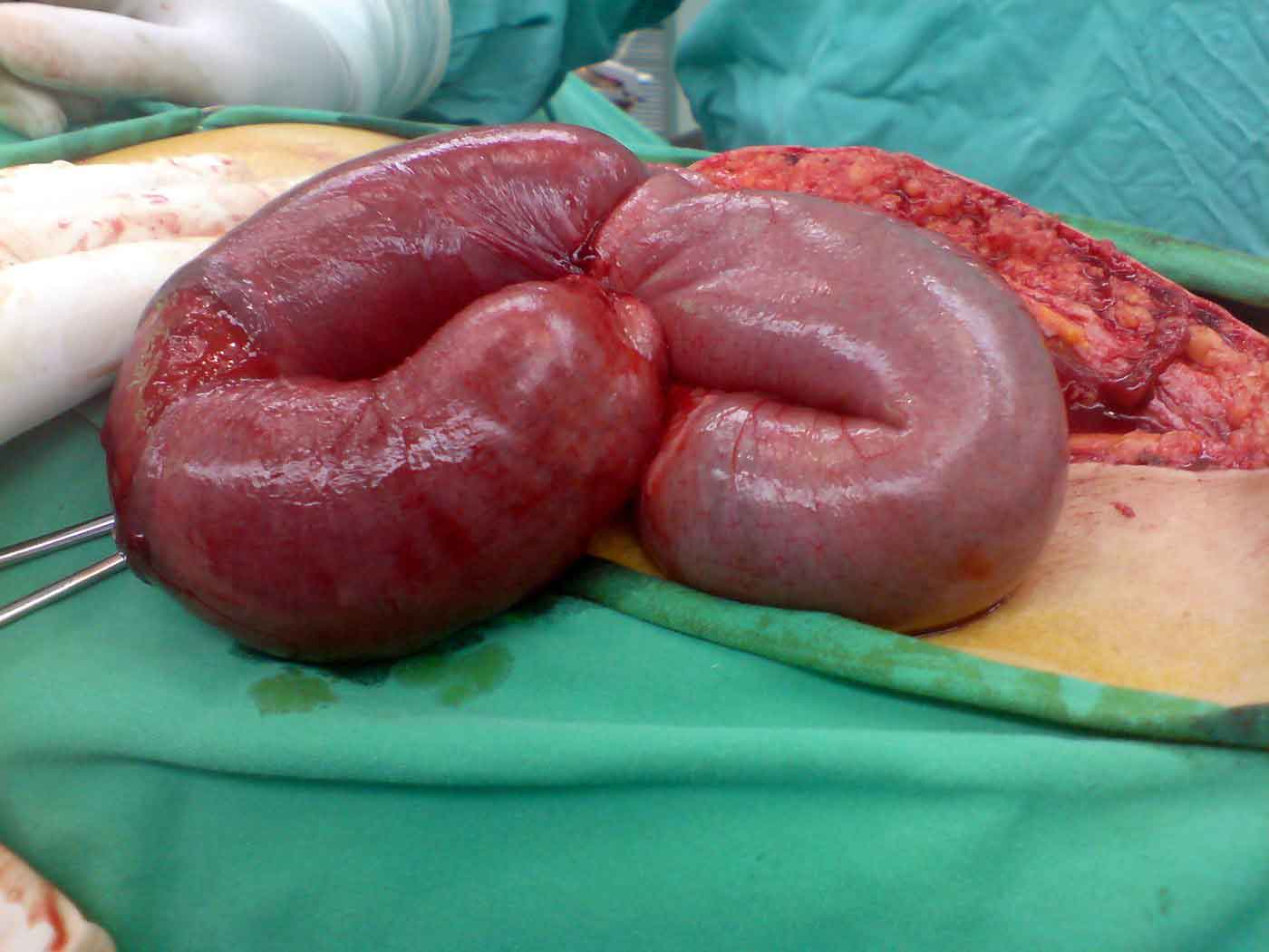 Abdominal CT scan showing large bowel obstruction with dilated colon