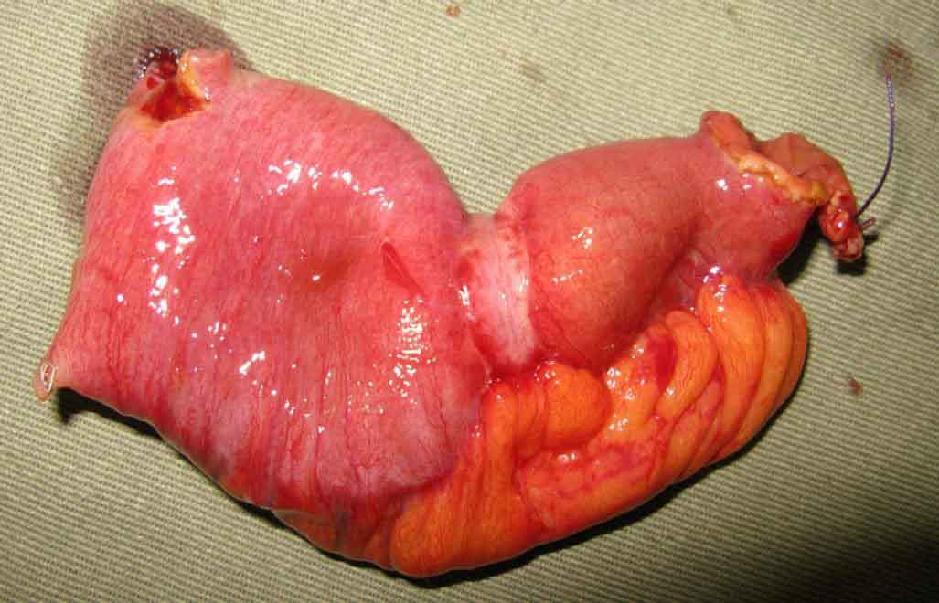 Diagram showing intestinal obstruction with distended loops of bowel